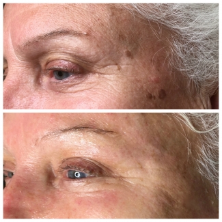 Elimination of Pigment Spots and Frown Lines