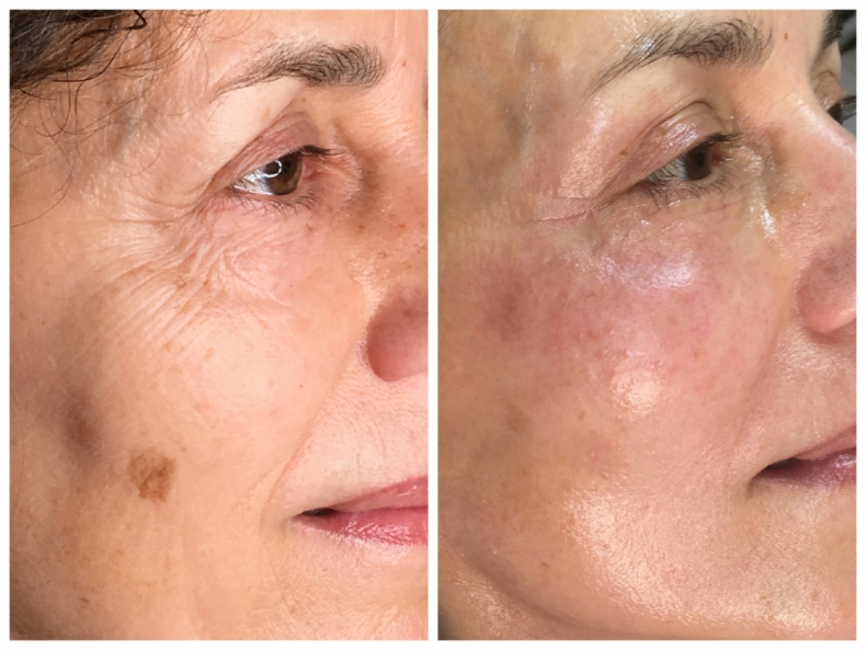 Facelifting - before/after