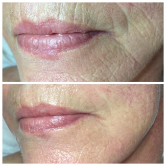 Tightening and Smoothing of Mouth Wrinkles