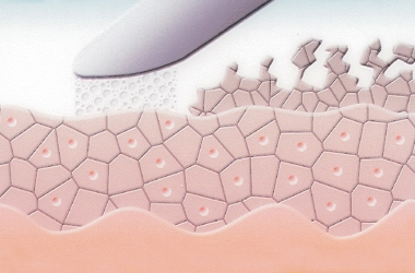 Mikrodermabrasion Schritt 2